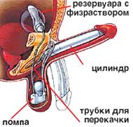ИСКУССТВЕННАЯ ЭРЕКЦИЯ: схема управляемого протеза полового члена