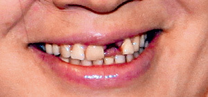 ...не придётся тратиться на протез