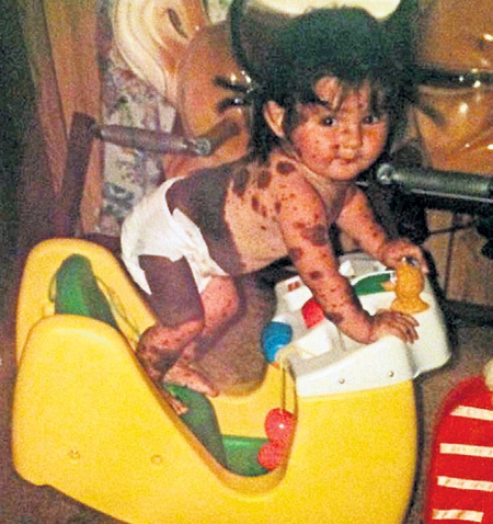 Сьера родилась с редкой формой генной мутации, которой страдает одни человек из 500 тысяч